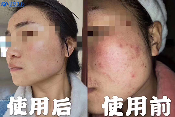 關(guān)于痘痘肌的清潔問(wèn)題-歐泉生化